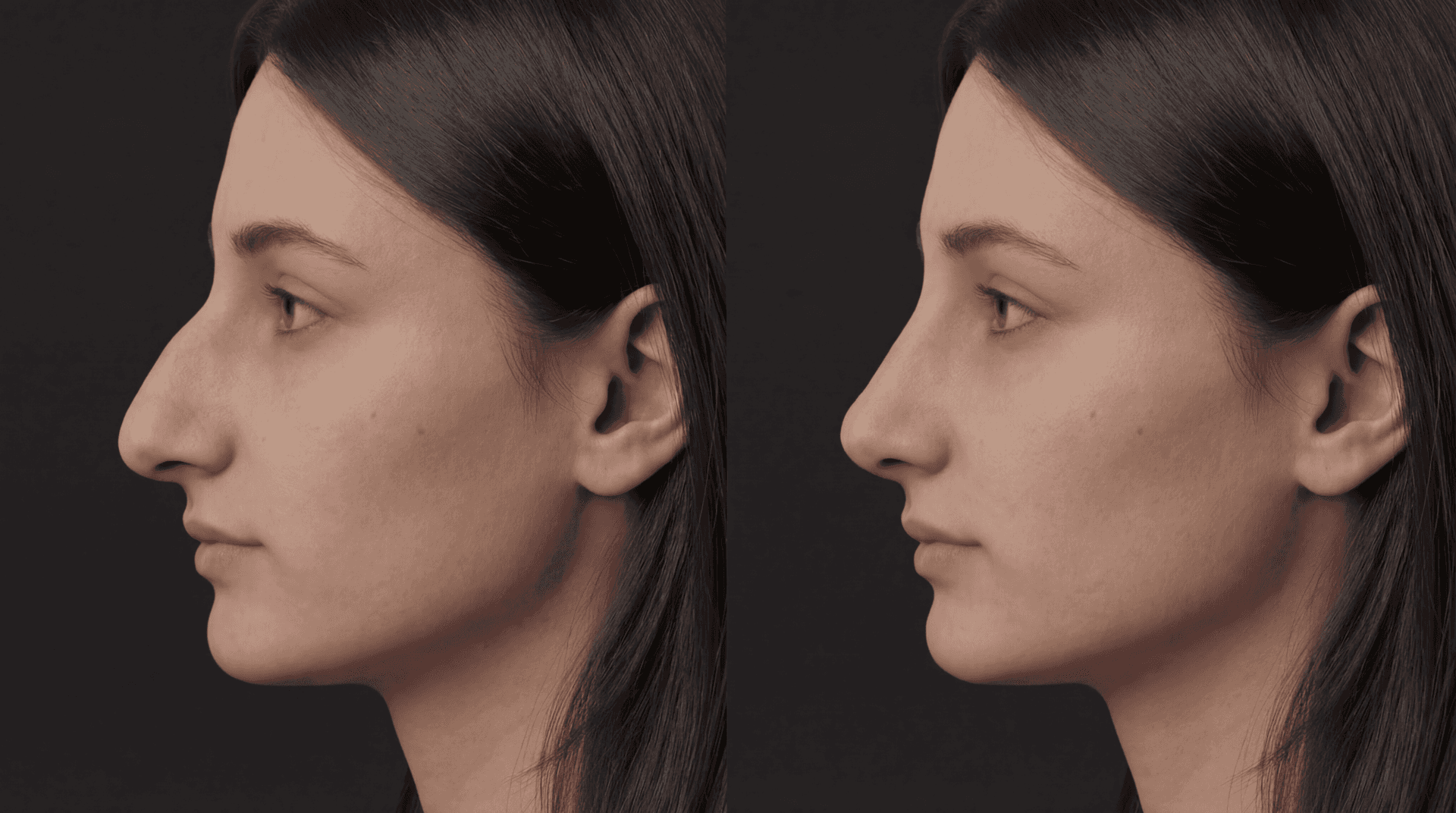 Ринопластика