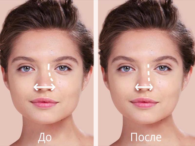 Подготовка к консультации по риносептопластике